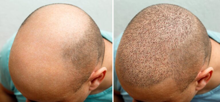 Hair Clinic in Turkey: A Comprehensive Guide to Hair Transplants